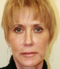 Feel Beautiful - Liquid Facelift with Radiesse - After Photo